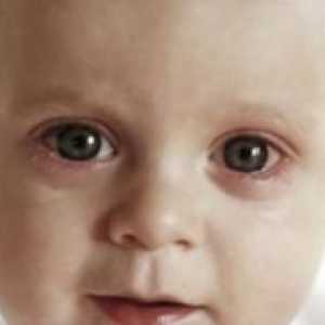 Червени очи бебе