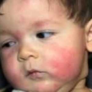 Лечение на хранителни алергии при децата