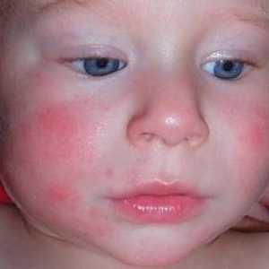 Лечение на различни форми на дерматит при бебета