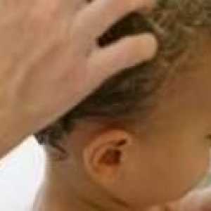 Лечение на себореен дерматит при деца