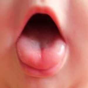 Петна по езика на детето