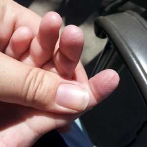 Поради какви причини се отлепят кожата на дланите на детето