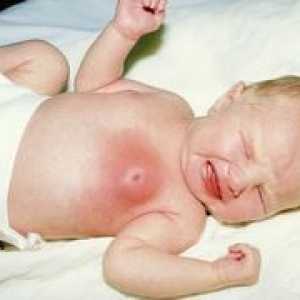 Защо новородено Уголемяване на гърдите?