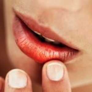 Причини и лечение на пукнатини в ъглите на устата