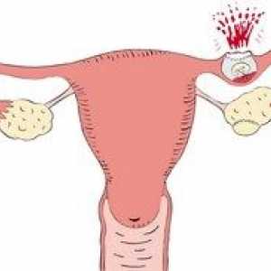 Причини и симптоми на извънматочна бременност