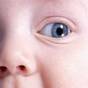Причините за образуване на синини под очите на деца