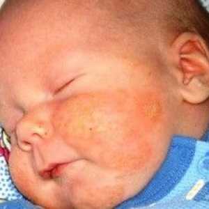 Причини, симптоми и лечение на алергии при децата