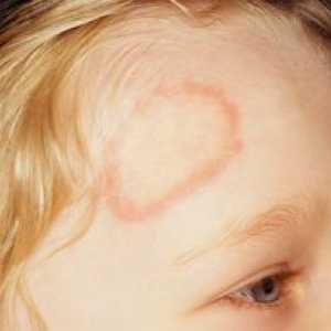Причини, симптоми и лечение на тения при деца