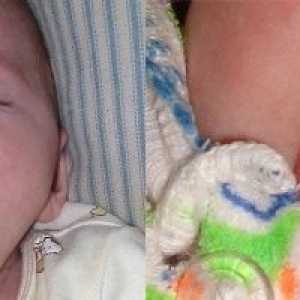 Причини, симптоми и лечение на гъбична инфекция при новородени