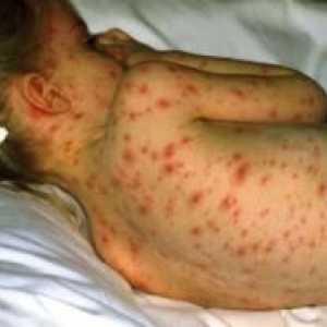 Симптомите на варицелата при децата