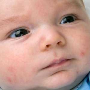 Симптоми, лечение и профилактика на стрептококовата дете