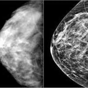 Симптомите на рак на гърдата и методи за ранна диагностика на болестта