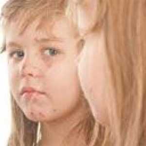 Симптомите на варицелата при децата