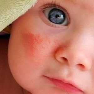 Трябва ли да се страхуваме от червени петна по лицето на новороденото?