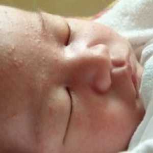 Обрив по лицето при новородени