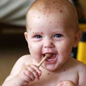Вашето бебе по-малко от една година, и той е болен от варицела?