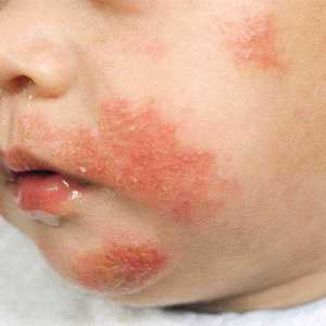 Видове дерматологични заболявания при децата
