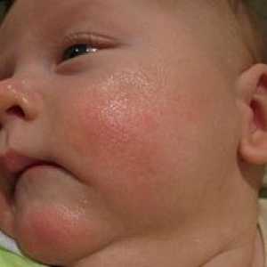Стафилококус ауреус при новородени